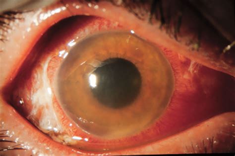 Uveitis Uveitis Eye Causes Types Symptoms Diagnosis Treatment
