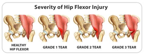 Tears Sprains Contusions Hsc Pdhpe