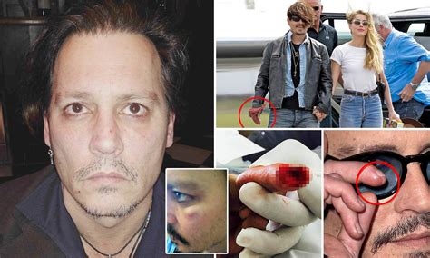 Johnny Depp Scars On Arm