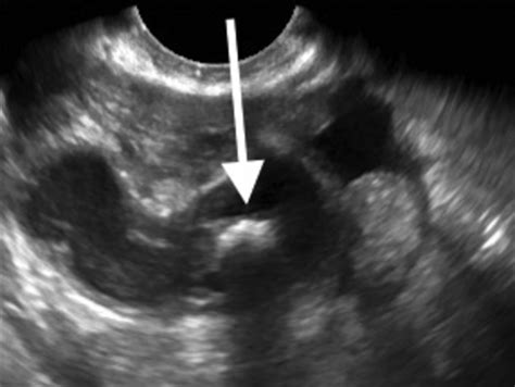 Abnormal Transvaginal Ultrasound