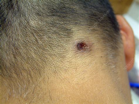 Sebaceous Cyst Removal Stock Image C0034515 Science Photo Library