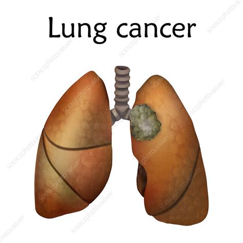 Lung Cancer Illustration Stock Image F0222031 Science Photo Library