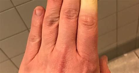 Half Of My Finger Goes Numb And Turns White Because Of Raynaud Syndrome