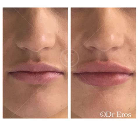 before and after lip filler dr eros avjioglu