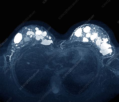Fibrocystic Breast Disease Mri Scan Stock Image C Science Photo Library