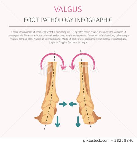 Foot deformation Valgus and varus infographic 插圖素材 PIXTA圖庫