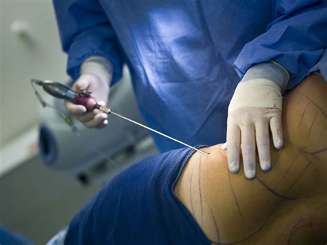 Liposucción Cuánto Cuesta La Cirugía Estética Para Eliminar La Grasa