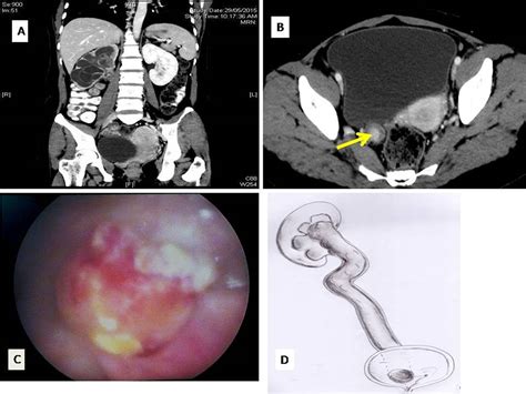 Giant Fibroepithelial Polyp Of The Ureter BMJ Case Reports