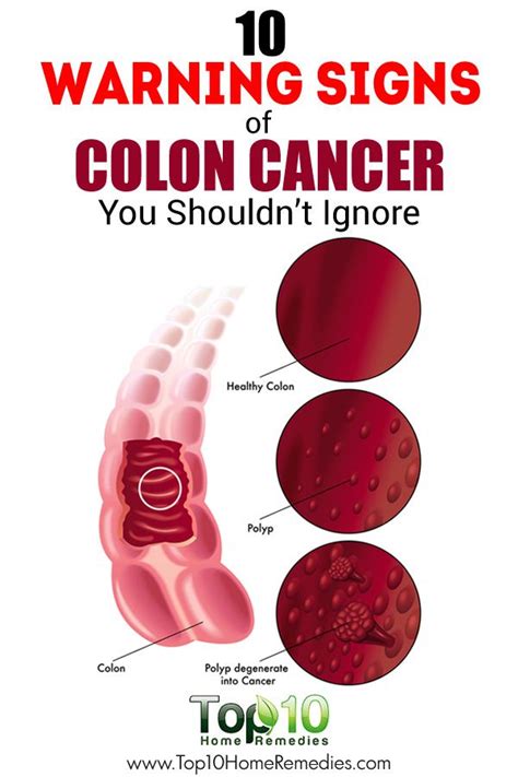 What Is One Of The First Signs Of Colon Cancer Colon Cancer Early