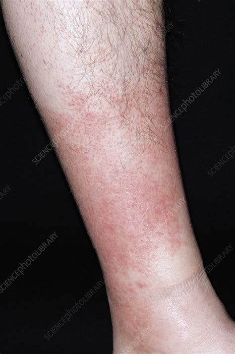 Cellulitis Of The Leg Stock Image C0110364 Science Photo Library