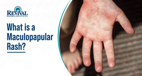 Maculopapular Rash Causes And Treatment