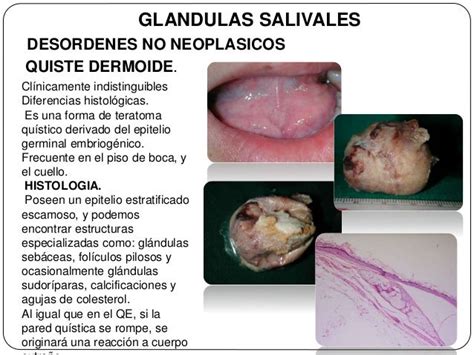 Tumores De Glandulas Salivales