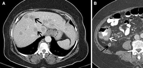 Cecal Mass With Secondary Appendicitis A Axial Ct Image Shows Multiple