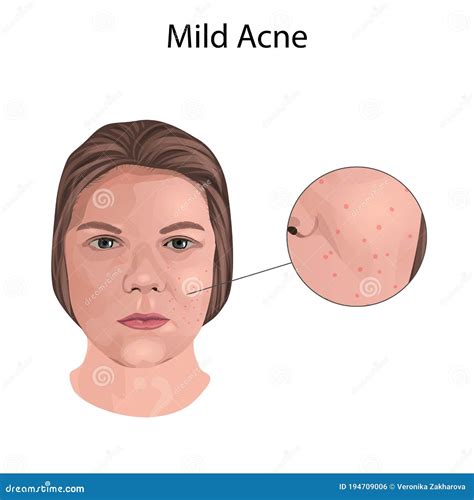 Mild Acne Young Woman Face With Skin Inflammation Close Up View