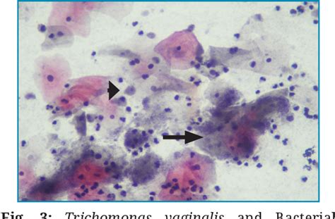 Figure 3 From Study Of Trichomonas Vaginalis And Bacterial Vaginosis In