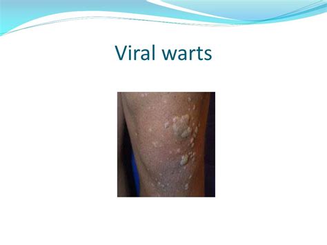 Ppt Skin Lesions Benign And Malignant Powerpoint Presentation Free