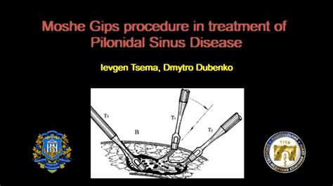 Moshe Gips Procedure In Treatment Of Pilonidal Sinus Disease Youtube