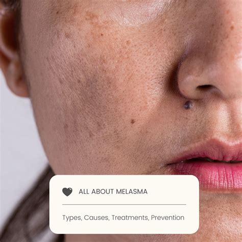 What Causes Melasma Treatments Types Prevention