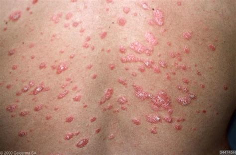 Causes Treatment And Symptoms Of Psoriasis