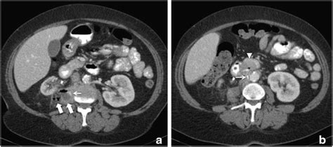 Abdominal Ct Scan At Admission Axial Slices Of A Contrast Enhanced