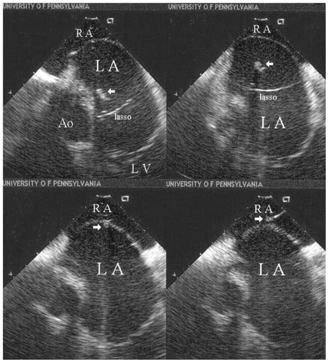 Left Atrial Thrombus Associated With Ablation For Atrial Fibrillation