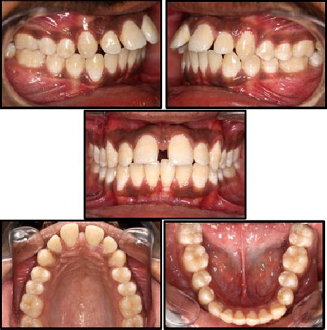 figure 2 from single phase correction of tongue thrust habit alongside fixed orthodontic