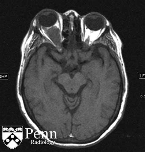 61 Year Old Woman With Facial Pain Headache Diplopia