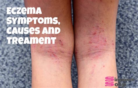 Eczema Symptoms Causes And Treatment Singapore Soap Supplies