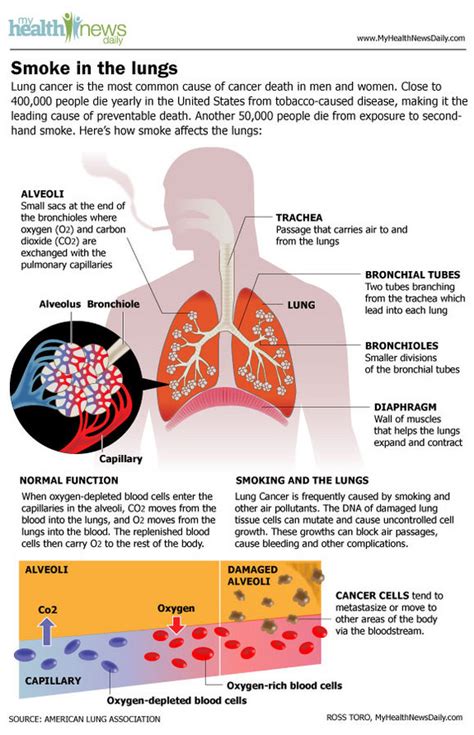Lung Cancer Signs Symptoms Types And Treatment