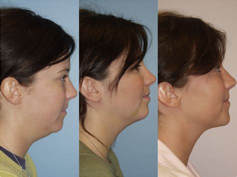 Chin And Submental Liposuction Northwestern Facial Plastic Surgery