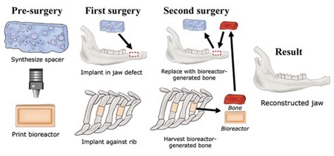 3d Printed Bioreactor Grown Bone For Craniofacial Surgery Applysci