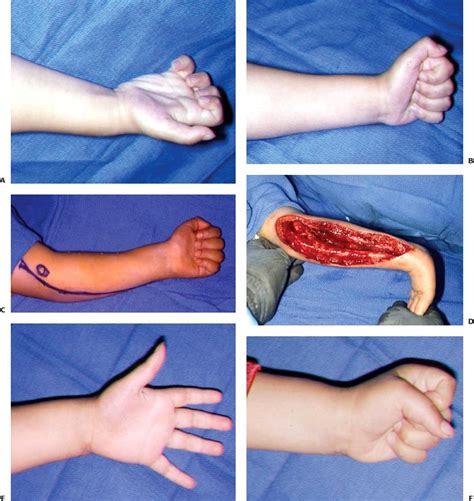 Compartment Syndrome In Children Musculoskeletal Key