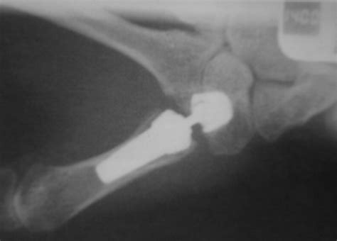 Treatment Of Advanced Cmc Joint Disease Trapeziectomy And Implant