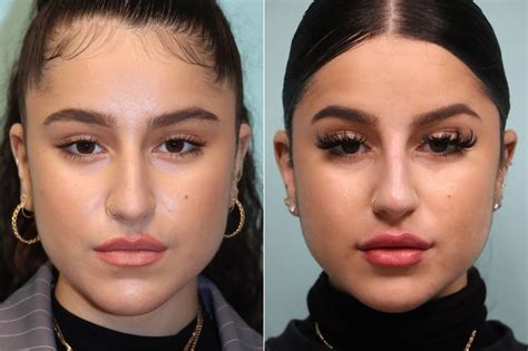 Lip Augmentation Before And After Photos Page Of The Naderi