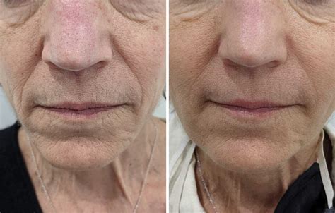 before and after sculptra skin treatments md beauty clinic