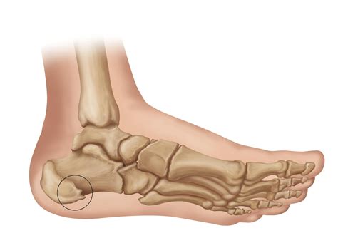 The Consequences Of Leaving Plantar Fasciitis Untreated Heel That Pain