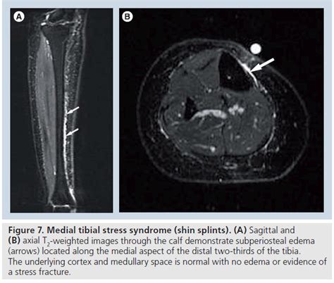 Medial Tibial Stress Syndrome