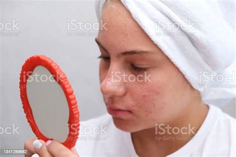 Sad Teenage Girl Problematic Skin In Adolescents Stock Photo Download