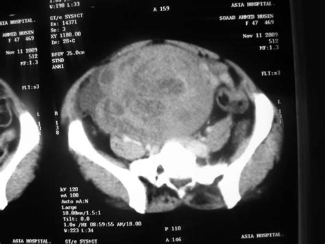 A Ovarian Carcinoma Pelvic Ct Scan Shows An Ovarian Mass With A