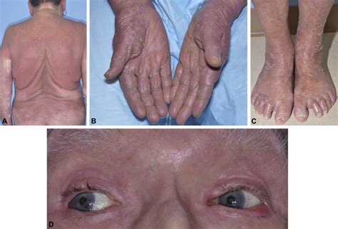 Primary Cutaneous T Cell Lymphoma Mycosis Fungoides And Sézary