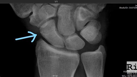 3 Weeks Into Healing A Scaphoid Fracture X Ray Any Thoughts On Healing