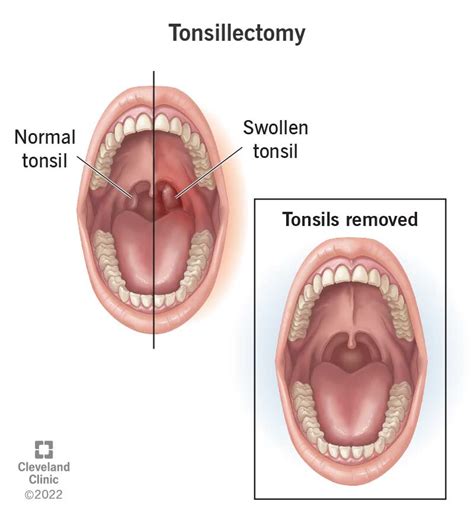 Tonsillectomy Procedure Details And Recovery