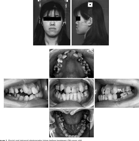 Figure 1 From Treatment Of A Patient With Metal Hypersensitivity After