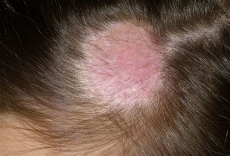 Cat hair loss could be a result of both mild and severe illnesses. Women's Hair Loss Pictures: Causes, Treatments, and More