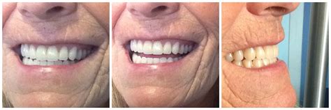 Immediate Complete Upper Lower Dentures Kelowna Denture Clinic