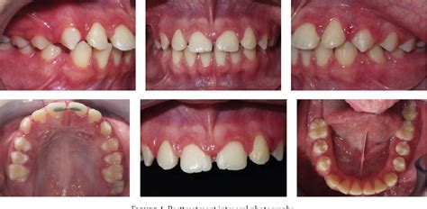 Figure 4 From When The Midline Diastema Is Not Characteristic Of The