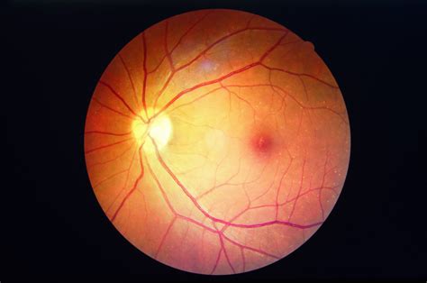 What Is A Macular Hole And How Does It Affect Your Vision Drs