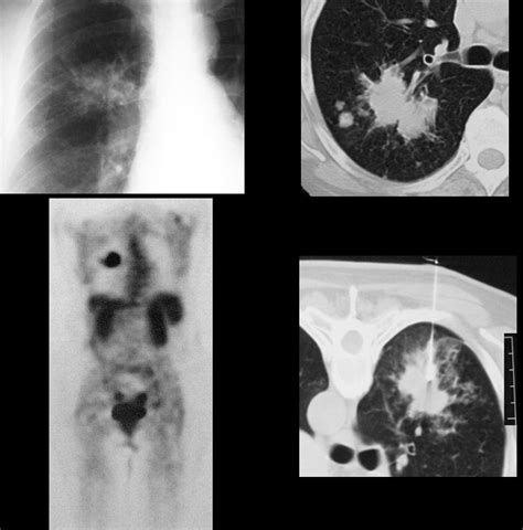 Nodules Spiculated Lungs