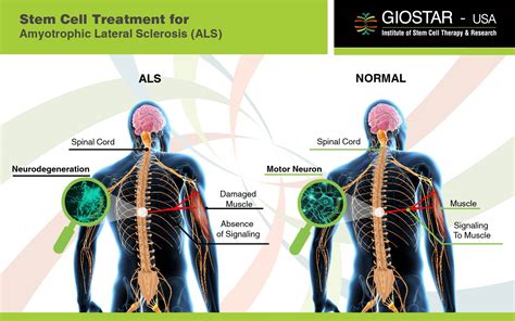 Amyotrophic lateral sclerosis (als), or lou gehrig's disease, is a rapidly progressive, degenerative neuromuscular disease that affects motor neurons. #ALS Treatment India, Stem Cell Treatment for Amyotrophic ...