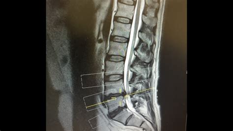 Management of slipped discs depends on many factors like age, symptoms, job profile of a person, time since the problem arises, the lifestyle of person, and many more. Day 6 after L4/L5 Microdiscectomy Lumbar Back Surgery for ...